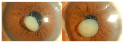 Figure 1 Anterior segment photographs show anterior dislocation of nucleus with multiple calcified spots in the remnant of posterior capsules of right and left eyes respectively.