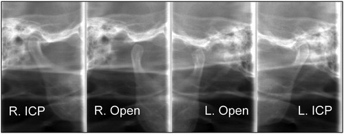 Figure 13. Radiographic images of TMJs at the 23-year follow-up. The right TMJ at ICP (far-left) and at jaw open position (center-left). The left condyle at ICP (far-right) and at jaw open position (center-right). Both condyles traveled enough anteriorly during jaw opening.