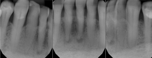 Figure 3. Teeth #24 and #25 are necrotic. Canal is visible toward apical third. Consider guided access.