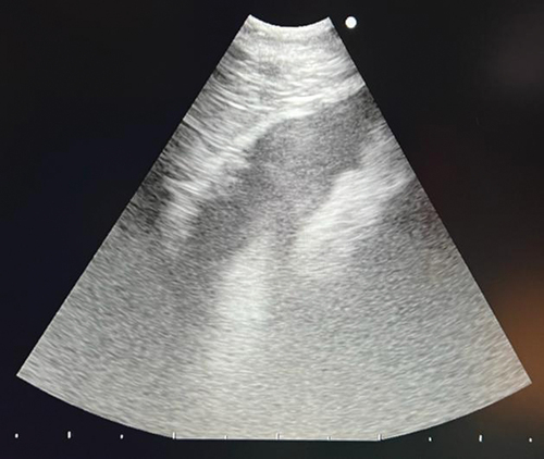 Figure 11. EUS-B image of a pericardial effusion.