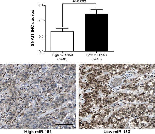 Figure 4 Correlation between miR-153 and SNAI1 in gastric cancer. In cases of low miR-153 expression, there was strong SNAI1 protein expression in the same tissue section. In contrast, in the case of high miR-153 expression, there was weak SNAI1 protein expression. Quantitative data showed that the expression of SNAI1 in tumors with high miR-153 expression was significantly lower than that in tumors with low miR-153 expression.