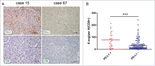 Figure 3. Immunohistochemical staining of human HCC tissues using anti-PD-L1 and CD8+ Abs. (A) FFPE tissue sections were analyzed by IHC for PD-L1 expression on tumor cells and CD8+ cell infiltration. PD-L1 positivity was defined as ≥ 5%, and the number of CD8+ cells was assessed in five distinct microscopic field (×200). (B) Tumors were classified as PD-L1+ and PD-L1− and analyzed for the amount of CD8+.