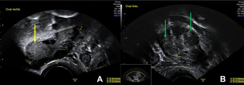 Figure 1 Sonographic findings of 03/2018: possible, small endometriotic lesions in the (A) right (yellow arrow) and (B) left (green arrows) ovaries.