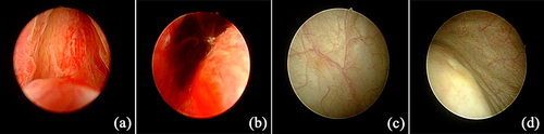 Figure 2 (a) Dilated blood vessels in the prostate and congested prostate glands; (b) Obvious bleeding in the prostate; (c) No bleeding point in the bladder mucosa; (d) No hematuresis spray at the ureteral orifice.
