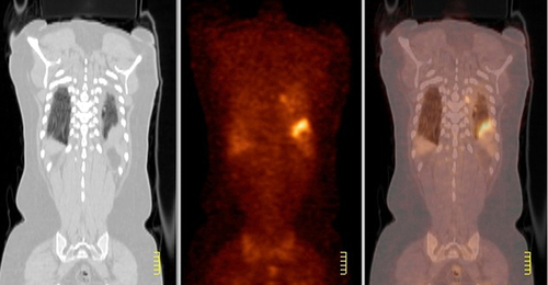 Figure 2 Positron emission tomography (PET)-CT revealed lung and left pleura metastasis.