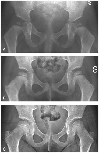 Figure 2. A. A girl with fragmentation of the left ossific nucleus (grade-1 AVN) at 12-month follow-up. Treatment had been initiated at 2 days of age for left-sided instability. B. Normal appearance of the femoral head at 3 years. C. Normal hip development at final check-up. The observation time was 5 years 7 months.