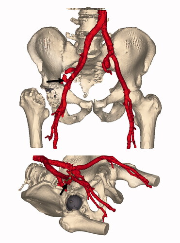 Figure 3. Segmentation of the contrast-enhanced vascular CT. Window ranges corresponding to intravascular contrast are colored red. The implanted metal backed cup is colored gray. The arrow is placed on the site of extravasation at the external iliac artery. Of note is the distance between the acetabular rim and the extravasation site.