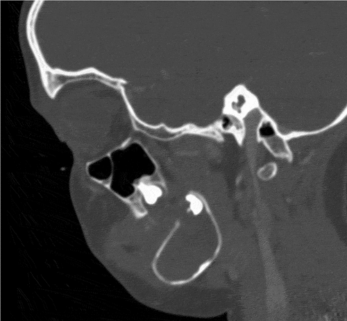 Figure 4. Sagittal CT image demonstrating the thinning of the superior and inferior cortices in the right posterior mandible. Also seen is the displaced crown of the second molar at the posterior-superior aspect of the lesion.