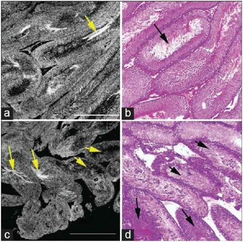 Figure 4. Comparative FFOCT and H&E-stained histology. (a) Testis of a normal rat shows seminiferous tubules with relatively uniform size and shape, (b) H&E histology stain of the same specimen. Arrows point to the sperm within the tubule lumen. (c) Seminiferous tubules in the testis of a rat treated with busulfan, showing thinner tubules and a greater degree of heterogeneity in size and shape with ~10% normal spermatogenesis. (d) H&E staining of the same specimen. Field of view in each panel: 1 mm2 Permission granted under the creative commons attribution license, Ramasamy et al. [Citation19]