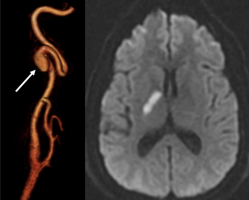 Figure 5 Right cervical internal carotid artery (ICA) dissecting pseudoaneurysm (white arrow) (reconstructed images from MRA) (figure on the left) and ipsilateral stroke on the ICA territory.