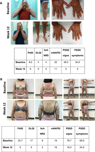 Figure 3 Visual treatment effects of IXE at Week 12. (A) Male aged 47 years from Italy; psoriasis for 6 years, bio-naïve, previous systemic conventional therapy, no PsA, diabetes mellitus, overweight, atherosclerosis, dyslipidemia, hypertension and liver disease, initiated IXE as per EMA label at baseline; (B) Female aged 45 from Taiwan; psoriasis for 19 years, bio-experienced, previous systemic conventional therapy, PsA and obesity, switched to IXE as per EMA label at baseline.