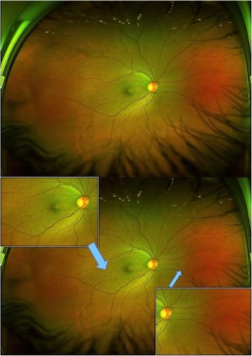 Figure 4 Shows the wide field of view of fundus with few dot retinal hemorrhages suggestive of mild NPDR (top). Bottom image shows the inset magnified views of the lesion areas (blue arrows), an advantage of this technology in manipulating the image to detect lesions more effectively.