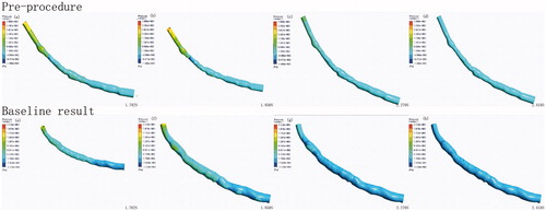 Figure 7. Wall pressure at different moments of isolated and realistically stented coronary artery.