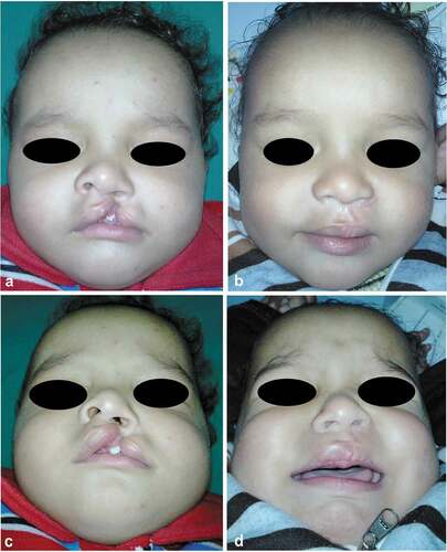 Figure 12. A case of Millard’s group; 4-month-old male, with left-sided unilateral incomplete cleft lip. (a and c) Preoperative frontal and submental views and (b and d) 3 months’ postoperative frontal and submental views