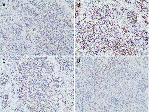 Figure 5 Immunohistochemistry showed MLH (+) (A), MSH2 (+) (B), MSH6 (+) (C), PMS2 (+) (D). That is mismatch-repair-proficient (pMMR) and microsatellite stable (MSS).