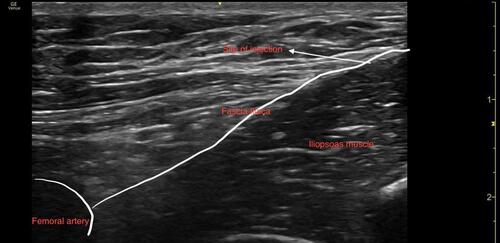 Figure 2 Fascia iliaca block (infrainguinal approach). The image shows the site of injection (white arrow), femoral artery, fascia iliaca and the iliopsoas muscle.