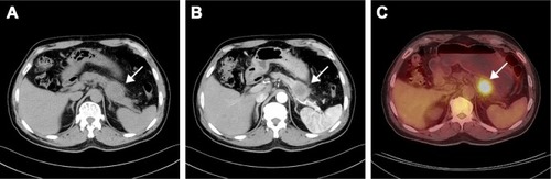 Figure 1 CT showed a 40 × 45 mm heterogeneous irregular hypodense mass in the distal body and tail of the pancreas (A), and it was enhanced after infusion of contrast material (B). PET-CT showed diffuse abnormal uptake only in the pancreatic mass (C).