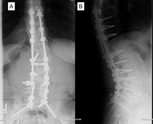 Figure 2 (A) PA and (B) lateral x-ray of patient who underwent T8-pelvis fusion and 2-years postoperatively experienced rod fracture at L4/5 on the left and pseudoarthrosis requiring reoperation. Of note, the right iliac set screw has also popped off.