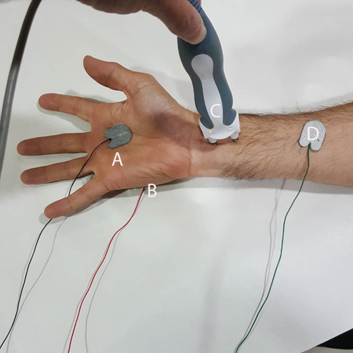 Figure 1 The sites of recording SSR from median nerve (A) active electrode on the palm; (B) reference electrode on the dorsal aspect of the hand, (C) ground electrode on the forearm and (D) stimulate median nerve on the wrist.