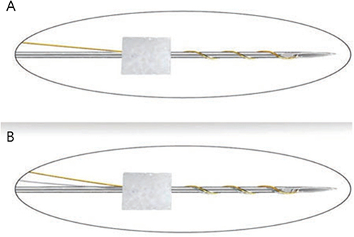 Figure 2 The ultra-fine construction of gold threads minimizes metallic sensations within tissues. Earlier models comprising solely gold threads (A) had a propensity to dislodge due to their rigid nature. The incorporation of PDO threads alongside gold ones (B) facilitated better anchoring within the skin, compensating for gold’s slower tissue reaction compared to PDO threads.