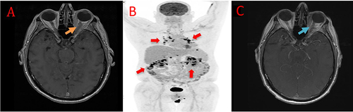 Figure 1 Axial view of magnetic resonance imaging (MRI) showed intraconal soft tissue and optic nerve sheath complex swelling [obscured the territories of different segments (Orange arrow)] (A). The positron emission tomography (PET) computed tomography demonstrated multiple fluorodeoxyglucose (FDG) avid lymph nodes above and below the diaphragm (red arrows) (B). MRI improved following the treatment [clear borders of segments (blue arrow)] (C).