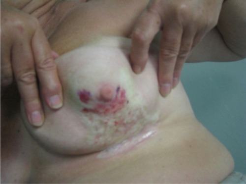 Figure 2 Two months after initial presentation, the involved area became pale, avascular, and covered by a transparent epithelial coat surrounded by multiple frail and thin telangiectasias with retraction of the skin in the inferior quadrants of the breast.