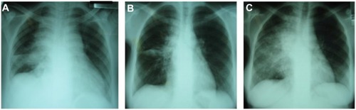 Figure 3 This series of three chest radiographs demonstrates features of paradoxical tuberculosis (TB) immune reconstitution inflammatory syndrome in a 21-year-old antiretroviral therapy (ART)-naïve patient, with CD4 count 34 cells/mm3, who was diagnosed with drug-sensitive pulmonary TB on sputum culture.