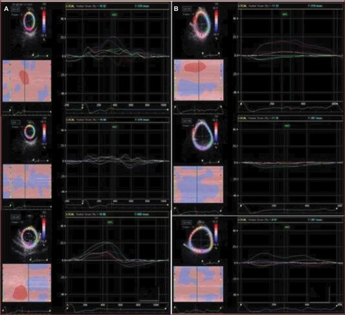 Figure 5 Speckle tracking imaging of the left ventricle radial strain, before (A) and after (B) doxorubicin therapy, in a control group patient.