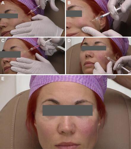 Figure 6 Clinical photo series of three stages of IOH treatment. Courtesy Jani van Loghem, MD. (A) Lateral Cheek (CPM-HA V); (B) Medial Cheek (CPM-HA V); (C) Palpebromalar groove (CPM-HA I); (D) Tear trough (CPM-HA B); (E) Result immediately after left side treated. Note the canthal tilt improvement.