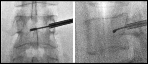 Figure 9 AP view (left) and lateral view (right) images showing final placement of J-stylet tip in lumbar vertebrae.