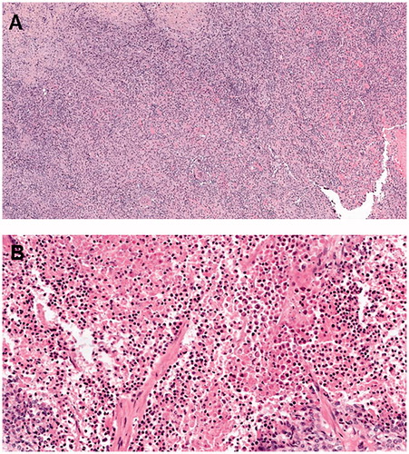 Figure 2. Histopathology of the surgical specimen showed chronic inflammatory lymphocytic and macrophagic infiltration surrounding tumor necrosis without residual tumor cell in case 1 (A) and chronic inflammatory lymphocytic infiltration and undifferentiated adenocarcinoma cells in case 2 (B).