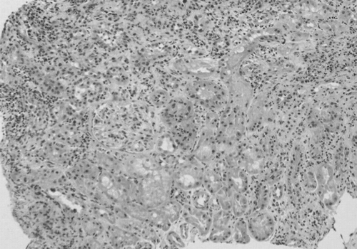 Figure 1. First renal biopsy specimen showing diffuse interstitial infiltrate of mononuclear cells with normal glomeruli (hematoxylin and eosin stain ×100).