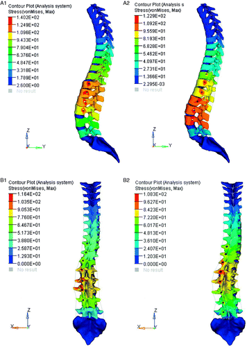Figure 6. Final spine stress distribution for the four solutions after the orthopedic correction procedure. The stress on most regions around the screw holes with solution A1 was greater than the ultimate strength of bone (120 Mpa), but with the other three solutions only a few nodes had stress exceeding this value.
