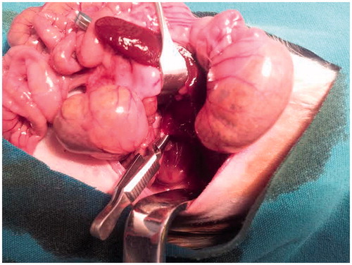 Figure 1. Placing atraumatic microvascular clamps to the renal pedicle for renal ischemia.
