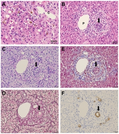 Figure 2 Light microscopic findings of liver biopsy. (A) Bile canalicular cholestasis findings showing edematous and pigmented hepatocytes around the central vein (arrowheads). “C” denotes the central vein. (B) Inflammatory infiltrate is made of polynuclear neutrophils and a varying number of eosinophils. Interlobular bile duct destruction is present in the portal tract. The arrow indicates destructive cholangitis. “P” denotes the portal vein. (C) HE and diastase-digested periodic acid-Schiff show intraepithelial neutrophilic infiltration in the interlobular bile duct. (D) Silver staining shows that basement membrane of the bile duct is preserved, but the nuclear arrangement is irregular. (E) Masson’s trichrome staining yields no evidence of portal fibrosis. (F) Cytokeratin 7 immunostaining shows positive cytoplasmic expression in the bile duct.