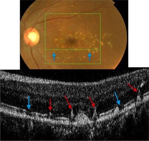 Figure 16 Fundus photograph (top) showing white FF flecks in the left eye of a patient with Stargardt disease; the B-scan line on the fundus photograph has the same width as the B-scan SD-OCT image (bottom) demonstrating areas of RPE migration (red arrows) and areas of RPE dropout (blue arrows).