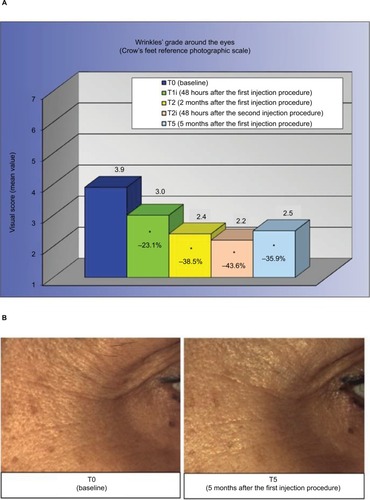 Figure 2 Evaluation of wrinkles around the eyes.