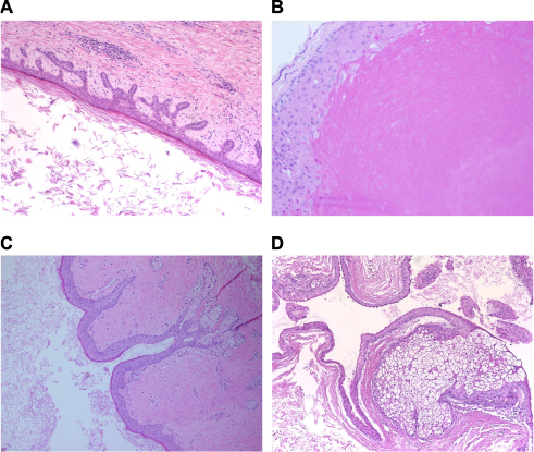 Figure 13 Dermal cysts.