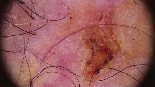 Figure 4 Trichoscopy picture showing absence of follicular openings, hemorrhagic crusts, and hair shaft tortuosity.