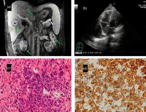 Figure 1. (A) MRI scan of the abdomen revealed multiple nodules scattered in the liver, kidney (arrows). (B) Echocardiography showed a mass in the right atrium (arrow). (C) Liver histopathology showed diffuse lymphoid proliferation, with clear cytoplasmic cells and large, round nuclei. HE staining; original magnification ×400. (D) Immunohistochemisty revealed cells were CD20 positive; original magnification ×400.