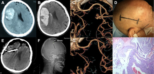 Figure 3 A 67-year-old man’s cAVMs removed via the transcranial neuroendoscopic approach. (A) CT scan at onset showing a hematoma in the right frontal lobe. (B) The hematoma was enlarged. (C) CTA showing a small AVM in the left frontal lobe. (D) A linear skin incision was made parallel to the Sylvain fissure. (E) Postoperative CT scan showing that the hematoma had been completely removed. (F) Postoperative image showing that the diameter of the bone flap was approximately 4 cm. (G) Postoperative CTA showing that the AVM had been completely removed. (H) Histopathologically confirmed arteriovenous malformations.