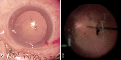 Figure 3. Diffuse small opacity of the anterior capsular membrane created obvious disturbance to the surgeon when using the three-dimensional platform. (A) Anterior segment photograph of Case 1; (B) Fundoscopy screenshot of Case 1 from the three-dimensional platform during the surgical procedure.