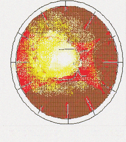 FIGURE 3  Retinal Map - Choroidal Detachment and Retinal Fibrosis.