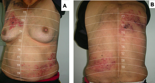 Figure 2 The left abdomen (Lt. T7-9) and the right thorax (Rt. T2-3) demonstrated clusters of papules and blisters on the basis of flaky erythema in a band-like distribution (A). The left lumbar region (Lt. T7-9) and the right dorsal region (Rt. T2-3) showed clusters of blisters on the basis of erythema distributed in bands (B). (Skin lesions after removing ink).