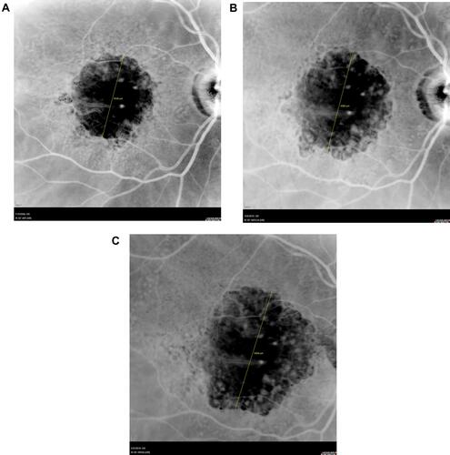 Figure 2 Infrared autofluorescence fundus photograph of age-related geographic atrophy at presentation (A), at the time of initial panmacular SDM treatment 51 months later (B), and at the last visit 43 months following initiation of panmacular SDM treatment (C).