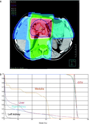 Figure 1.  a: 3 dimensional radiotherapy dose plan. The red and the blue lines depict the gross tumour volume (GTV) and clinical target volume, respectively. The red area marks 95% of the prescribed dose. b: Cumulative dose volume histograms for the GTV and organs at risk.