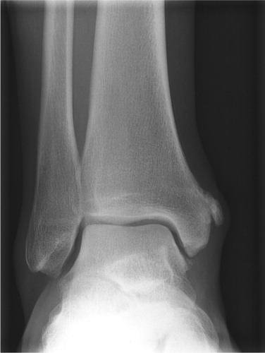 Figure 1. Avulsion of the periosteum above the insertion of the deltoid ligament.