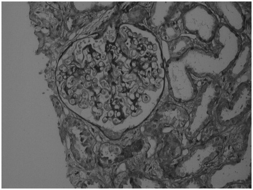 Figure 3. Kidney biopsy showing acute tubular injury, interstitial edema with intratubular pigmented granular casts and unremarkable glomeruli. The morphological features are consistent with acute tubular injury associated with pigment nephropathy.