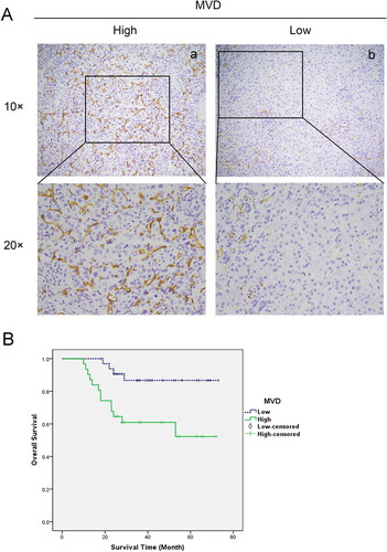 Figure 2. Microvessel density (MVD) in hepatoblastoma tissues. (A) Immunohistochemistry for CD34 in hepatoblastoma tissues; (a) Higher MVD expression (x100). (b) Lower MVD expression (x100). (B) Kaplan–Meier analysis of overall survival in patients with hepatoblastoma based on MVD (P = 0.009).
