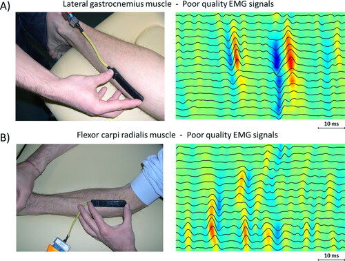 Figure 4. Examples of sEMG signals of poor quality from two different muscles. (A) Signal recorded from Soleus muscle, where it is not possible to identify an IZ (although two MUAPs are clearly visible). (B) Signal recorded from upper Flexor Carpi Radialis muscle, where the EMG signals do not allow identification of IZ.